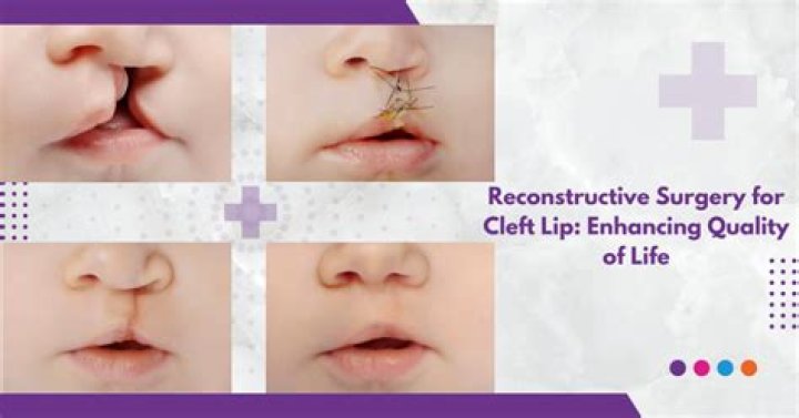 Expert Mouth Birth Defect Cosmetic Surgery in Lebanon